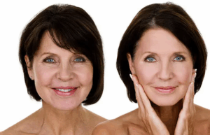 rosto-de-mulher-bonita-mais-de-55-anos-antes-e-depois-Lifting-facial.png